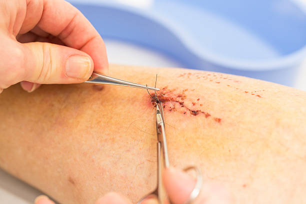 istock Nurse is removing stitches from a wound on patients leg 187864483