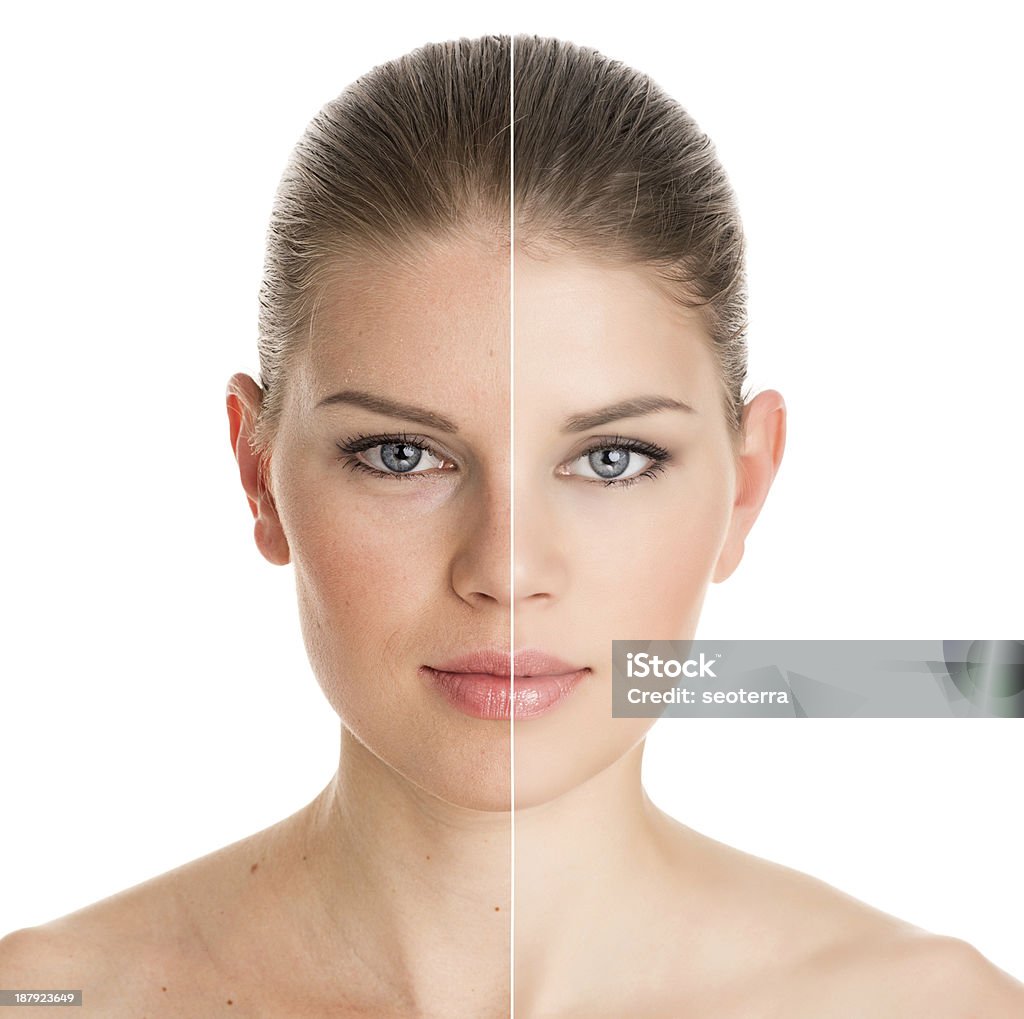 Before and after cosmetic operation Before and after cosmetic operation. Young pretty woman portrait, isolated on a white background. Botulinum Toxin Injection Stock Photo