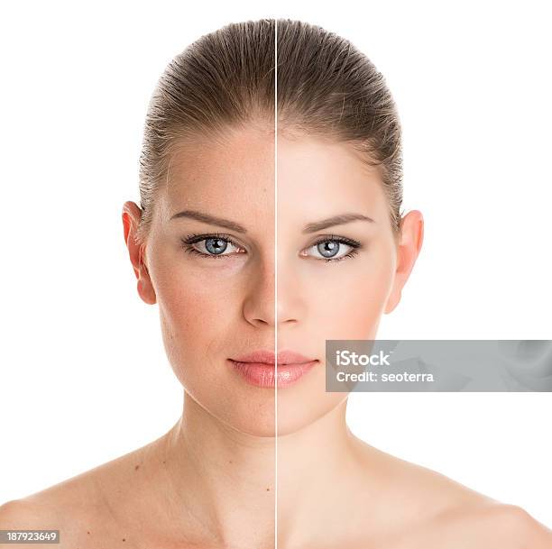 Before And After Cosmetic Operation Stock Photo - Download Image Now - Botulinum Toxin Injection, Change, Women