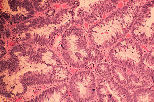Colonic adenocarcinoma with H&E Staining Microscopic image of colonic adenocarcinoma with Hematoxylin and eosin stain (H&E stain) adenocarcinoma photos stock pictures, royalty-free photos & images