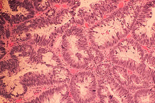 Photo of Colonic adenocarcinoma with H&E Staining