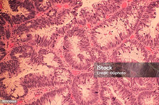 Foto de Colonic Adenocarcinoma Com H E Manchas e mais fotos de stock de Câncer colorretal - Câncer colorretal, Célula, Cólon