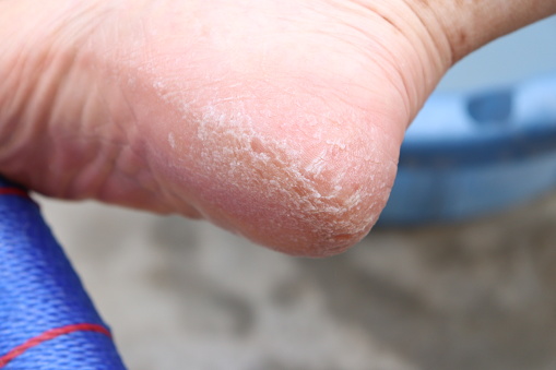 Closeup of an Indian Lady feet and ankles with vitiligo and dry foot or dry ankle or cracked heel, closeup