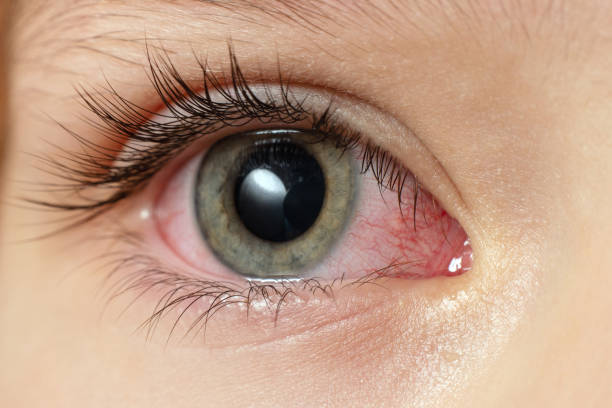 istock Closeup irritated infected red bloodshot eyes, conjunctivitis 1879551422