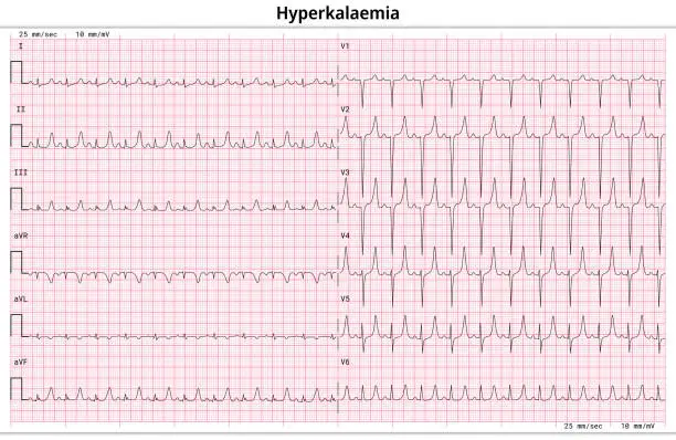 Vector illustration of ECG Hyperkalemia - Hyperkalaemia - 12 Lead ECG Common Case - 6 Sec/lead