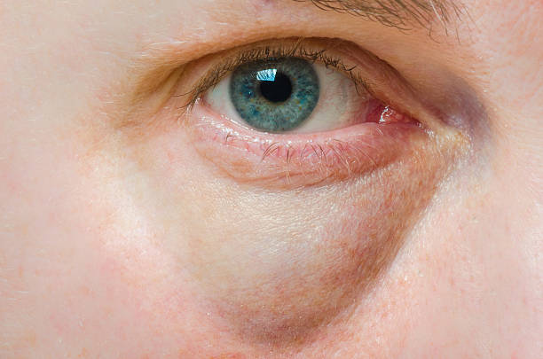 puffy inflamación ocular - demasiado grande fotografías e imágenes de stock