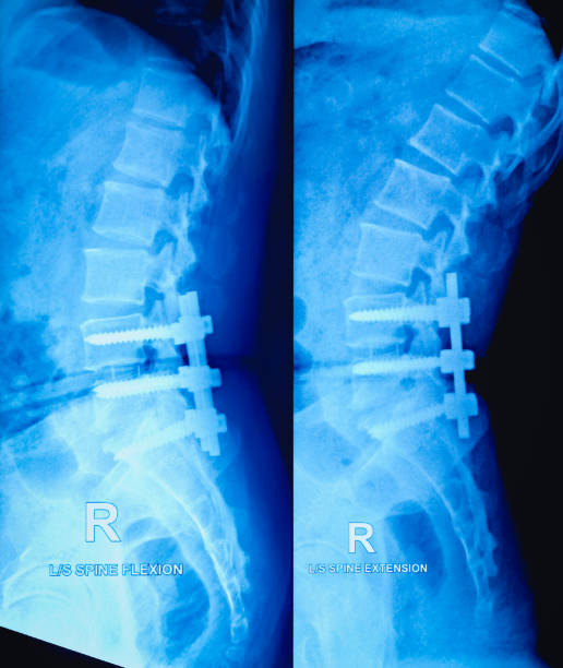 radiografia da coluna lombossacral feminina, vista em flexão e extensão. - thoracic vertebrae - fotografias e filmes do acervo