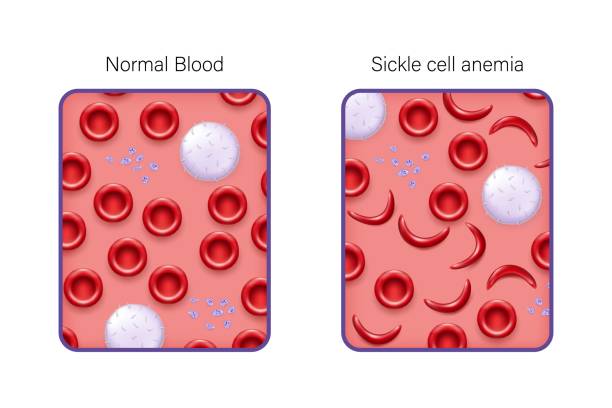 überträger der sichelzellkrankheit. der unterschied zwischen normaler roter blutkörperchen und sichelzellenanämie. rote blutkörperchen, weiße blutkörperchen und blutplättchen. - sickle cell anemia red blood cell blood cell anemia stock-grafiken, -clipart, -cartoons und -symbole