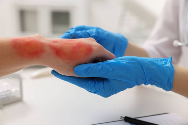 istock Doctor examining patient's burned hand indoors, closeup 1885930817