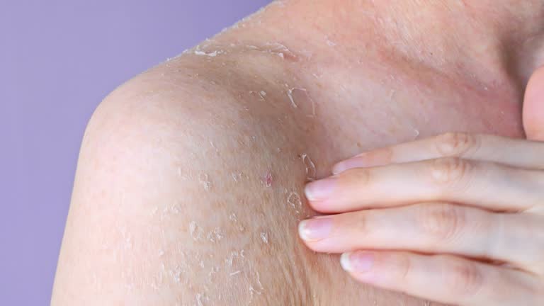 Problematic dry skin on shoulder close-up front view flaking as consequence of dry skin dehydration and dermatitis, concept of health problem dry skin and personal hygiene self care