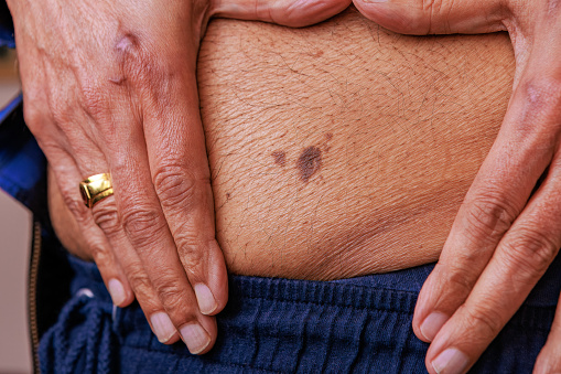 A close-up of a large skin mole on the belly of a 76-year-old Asian Indian man, framed by his hands.