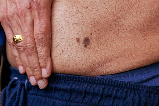A close-up of a large skin mole on the belly of a 76-year-old Asian Indian man. His right hand is visible in the image.