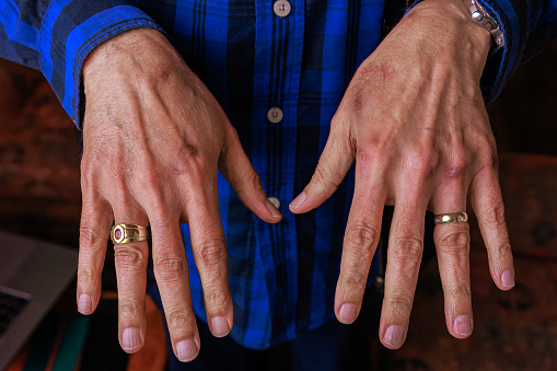 A close-up of the scars on the hands of a 76-year-old Asian Indian Man. The scars are the result of a fall 4 months before the date on which the image was shot. Given the nature of South Asian skin, it would probably take about 8 years for the scars to disappear.