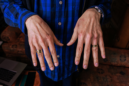 A close-up of the scars on the hands of a 76-year-old Asian Indian Man. The scars are the result of a fall 4 months before the date on which the image was shot. Given the nature of South Asian skin, it would probably take about 8 years for the scars to disappear.