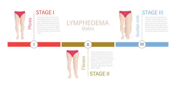 Vector illustration of Different stages of leg lymphedema