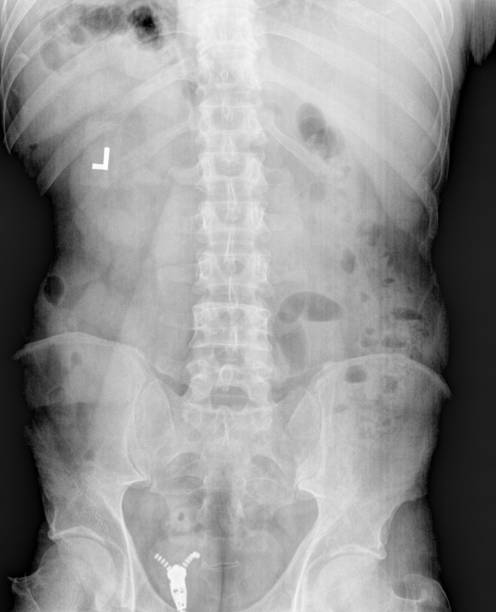 정상적인 뼈 구조를 보여주는 정상 성인 요추 전방 후방 ap 보기의 필름 x선 또는 방사선 사진 - x ray image x ray back low 뉴스 사진 이미지