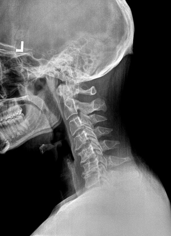 Film x ray or radiograph of a cervical neck. Lateral side view showing straightening or slight kyphosis normally seen after a whiplash injury with degneration of C6 and C7 disc