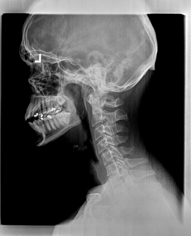 Film x ray or radiograph of a cervical neck. Lateral side view showing straightening or slight kyphosis normally seen after a whiplash injury with arcuate foramen of C1 and occiput