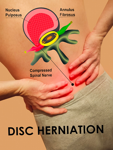 Pain in the spine, man with backache on black background, intervertebral hernia or disc injury concept, Difference between Bulging Disc and Herniated Disc. Stages of Spinal Disc extrusion.