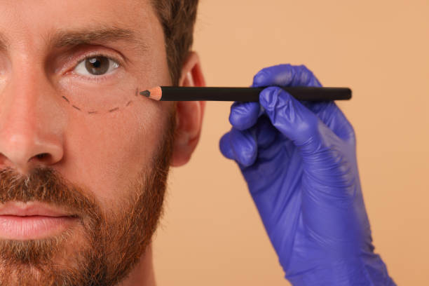 istock Doctor drawing marks on man's face for cosmetic surgery operation against beige background, closeup 1893575375