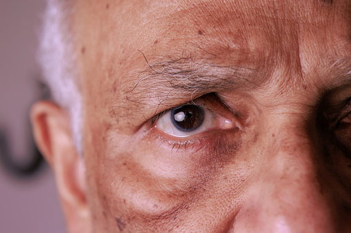 This 76-year-old Asian Indian man has an eye stye inside the lower eyelid of his right eye. A swelling towards the nose side of the eyelid is visible. Focus on the eye—studio shot.