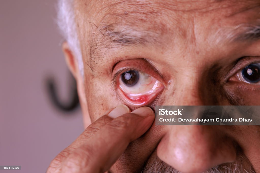 Eye Stye inside the Lower Eyelid of a 76-year-old Asian Indian Male This 76-year-old Asian Indian man has an eye stye in the lower eyelid of his right eye. He pulls his eyelid down to show the stye which is quite red. Focus on his right eye—studio shot. 70-79 Years Stock Photo Eye Stye inside the Lower Eyelid of a 76-year-old Asian Indian Male This 76-year-old Asian Indian man has an eye stye in the lower eyelid of his right eye. He pulls his eyelid down to show the stye which is quite red. Focus on his right eye—studio shot. 70-79 Years Stock Photo