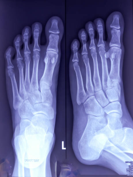 istock X-ray of foot both view. foot xray. ankle joint. 1898289795