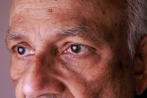 This 76-year-old Asian Indian man has an eye stye inside the lower eyelid of his right eye. A swelling towards the nose side of the eyelid is visible. Focus on his left eye, which is the good eye—studio shot.