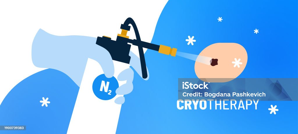 Cryotherapy Process Targeted Cryotherapy Procedure For Mole On Skin Medical Instrument With ...