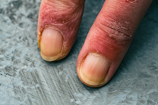 Close up of a mature woman with chilblains to her fingers.