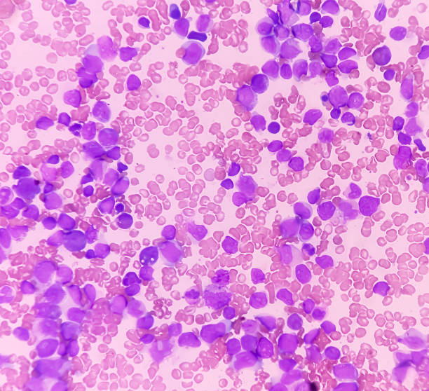 blood cancer. photomicrograph of acute myeloblastic leukemia or aml, a cancer of white blood cell. peripheral blood smear showing cancer cells. - cancer cell flash стоковые фото и изображения