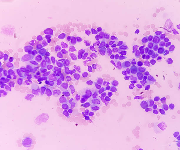 rak krwi. mikrofotografia ostrej białaczki mieloblastycznej (aml), nowotworu białych krwinek. badanie szpiku kostnego. mikroskopijny rozmaz bms. - cancer cell flash zdjęcia i obrazy z banku zdjęć