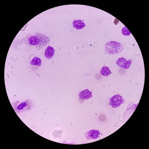 rak krwi. mikrofotografia ostrej białaczki mieloblastycznej (aml), nowotworu białych krwinek. rozmaz krwi obwodowej pokazujący komórki rakowe. - cancer cell flash zdjęcia i obrazy z banku zdjęć