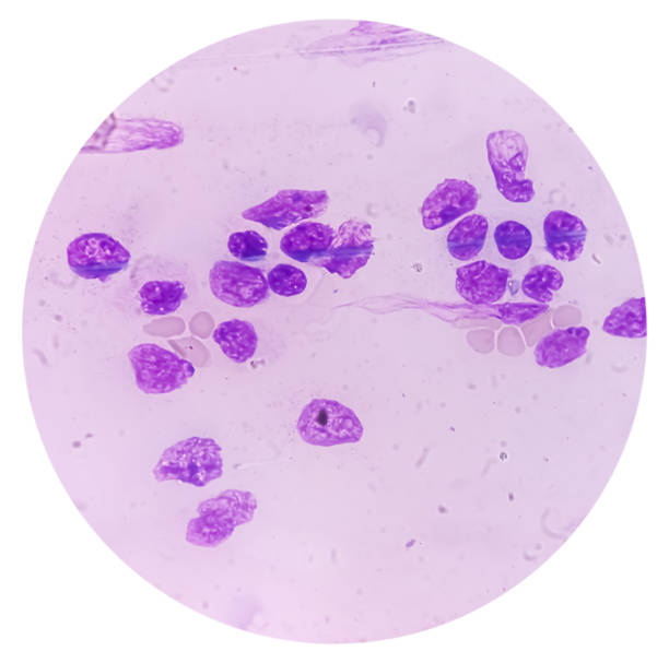 blood cancer. photomicrograph of acute myeloblastic leukemia or aml, a cancer of white blood cell. peripheral blood smear showing cancer cells. - cancer cell flash zdjęcia i obrazy z banku zdjęć