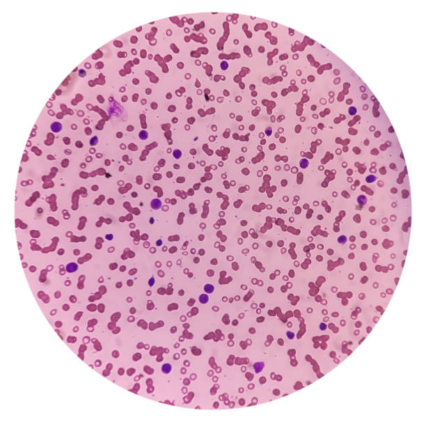 blood cancer. photomicrograph of acute myeloblastic leukemia or aml, a cancer of white blood cell. peripheral blood smear showing cancer cells. - cancer cell flash zdjęcia i obrazy z banku zdjęć