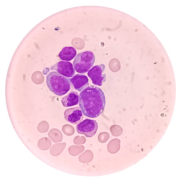 blood cancer. photomicrograph of acute myeloblastic leukemia or aml, a cancer of white blood cell. peripheral blood smear showing cancer cells. - cancer cell flash стоковые фото и изображения