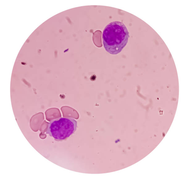 blood cancer. photomicrograph of acute myeloblastic leukemia or aml, a cancer of white blood cell. peripheral blood smear showing cancer cells. - cancer cell flash zdjęcia i obrazy z banku zdjęć