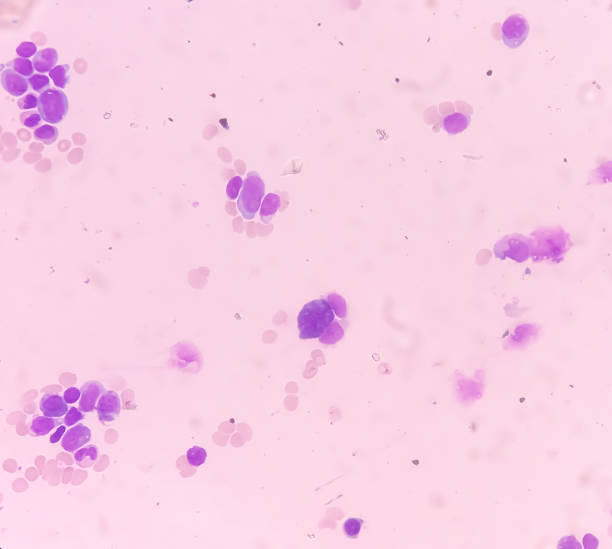 blood cancer. photomicrograph of acute myeloblastic leukemia or aml, a cancer of white blood cell. peripheral blood smear showing cancer cells. - cancer cell flash стоковые фото и изображения