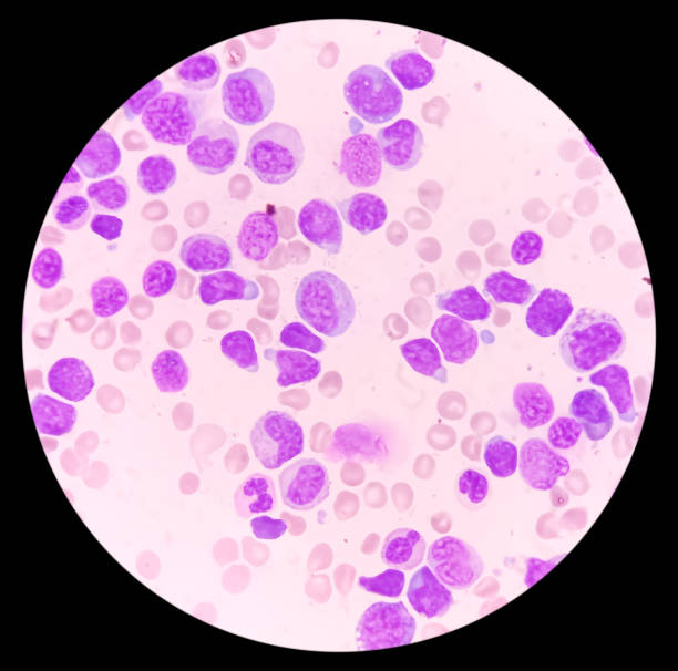 blood cancer. photomicrograph of acute myeloblastic leukemia or aml, a cancer of white blood cell. bone marrow study. microscopic of bms smear. - cancer cell flash стоковые фото и изображения
