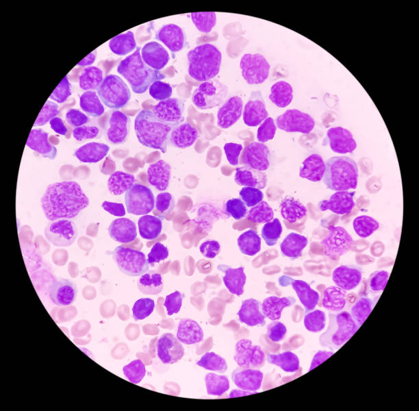 blood cancer. photomicrograph of acute myeloblastic leukemia or aml, a cancer of white blood cell. bone marrow study. microscopic of bms smear. - cancer cell flash zdjęcia i obrazy z banku zdjęć