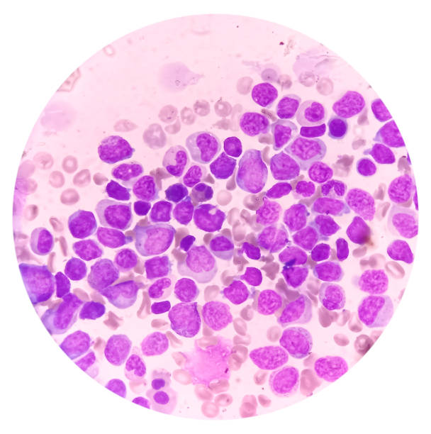 blood cancer. photomicrograph of acute myeloblastic leukemia or aml, a cancer of white blood cell. bone marrow study. microscopic of bms smear. - cancer cell flash стоковые фото и изображения