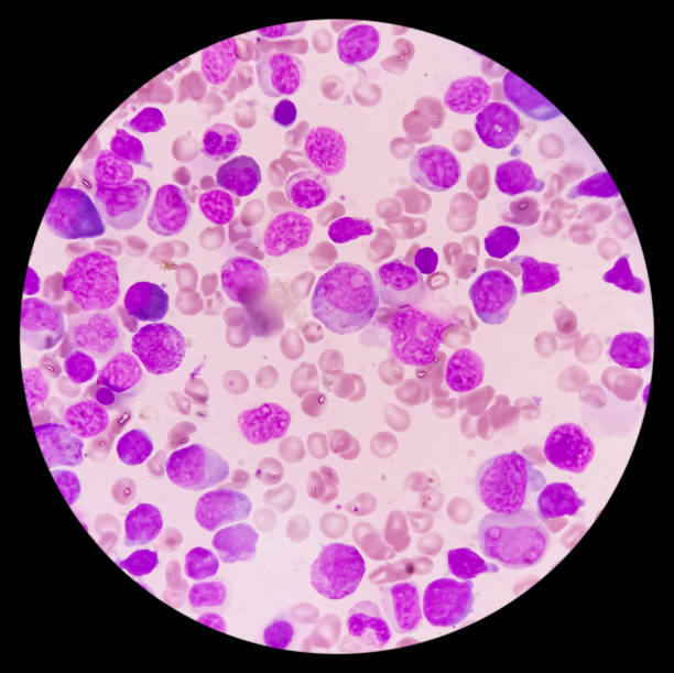 blood cancer. photomicrograph of acute myeloblastic leukemia or aml, a cancer of white blood cell. bone marrow study. microscopic of bms smear. - cancer cell flash zdjęcia i obrazy z banku zdjęć