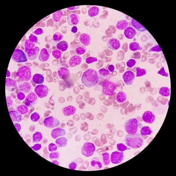 blood cancer. photomicrograph of acute myeloblastic leukemia or aml, a cancer of white blood cell. bone marrow study. microscopic of bms smear. - cancer cell flash стоковые фото и изображения