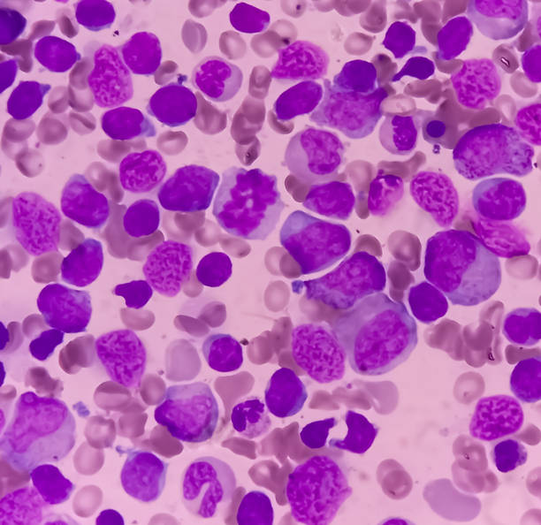 blood cancer. photomicrograph of acute myeloblastic leukemia or aml, a cancer of white blood cell. bone marrow study. microscopic of bms smear. - cancer cell flash стоковые фото и изображения