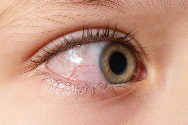 closeup irritated infected red bloodshot eyes, conjunctivitis - conjunctivitis sore eyes child human eye photos et images de collection