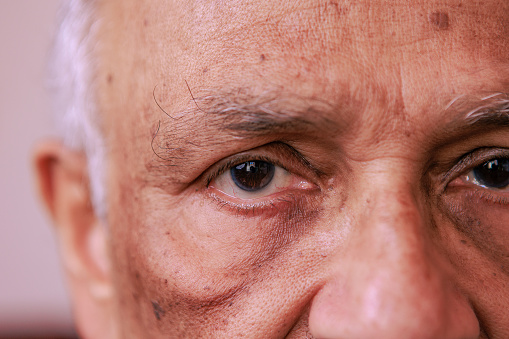 This 76-year-old Asian Indian man has an eye stye in the lower eyelid of his right eye. The inflammation below the lower eyelid on the side closer to the nose is visible. Focus on his right eye. Studio shot.
