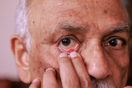 This 76-year-old Asian Indian man has an eye stye in the lower eyelid of his right eye. He pulls his eyelid down to show the stye which is quite red. Focus on his right eye. Studio shot.