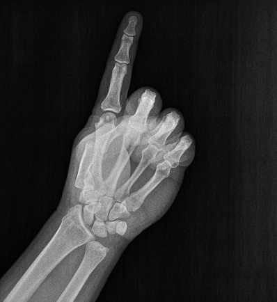 Film xray x-ray or radiograph of a hand and fingers showing the number one 1 in gestural language, manual communication, or signing aka sign language, we are number # 1 or first place