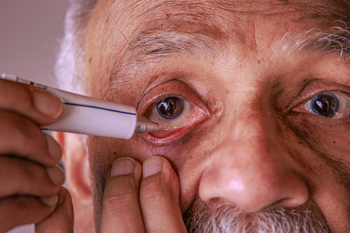 This 76-year-old Asian Indian man has an eye stye in the lower eyelid of his right eye. He is seen applying an ointment for the ailment. Focus on the eye—studio shot.