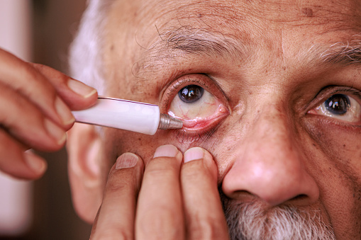 This 76-year-old Asian Indian man has an eye stye in the lower eyelid of his right eye. He is seen applying an ointment for the ailment. Focus on the eyestudio shot.